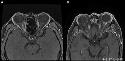 Optic Perineuritis and Its Association With Autoimmune Diseases